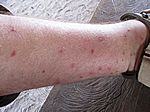 mein Blut schmeckt wohl besonders gut